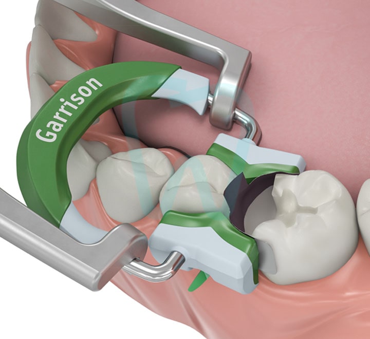 Fussion Tight Wide Prep – رینگ سکشنال گریسون - تصویر 2