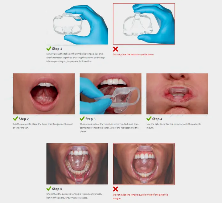 Umbrella Cheek Retractor – دهان بازکن چتری الترادنت - تصویر 2